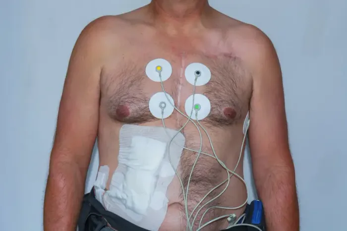 LVAD Heart Pump Life Expectancy Explained